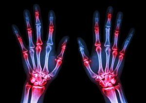 cbd arthritis